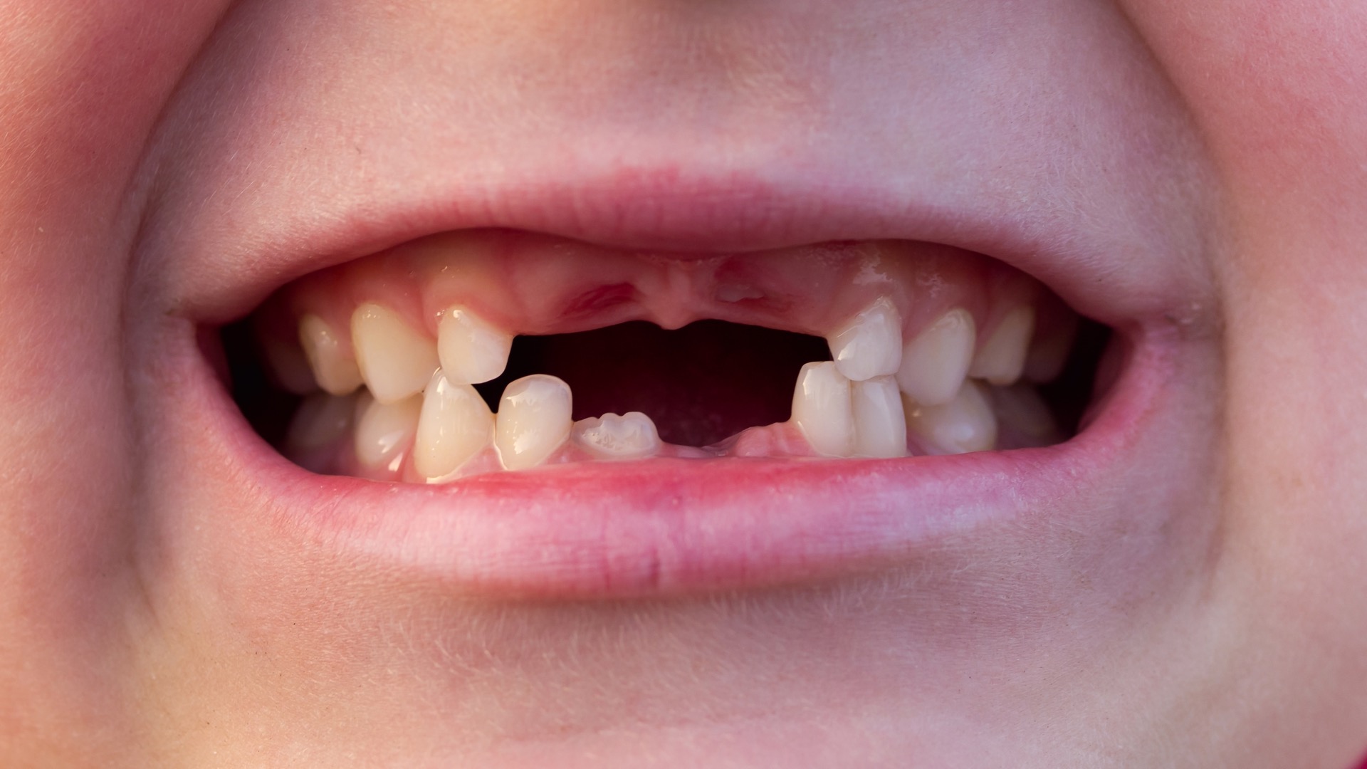 Kdaj izpadejo mlečni zobje in ali je potreben ortodont