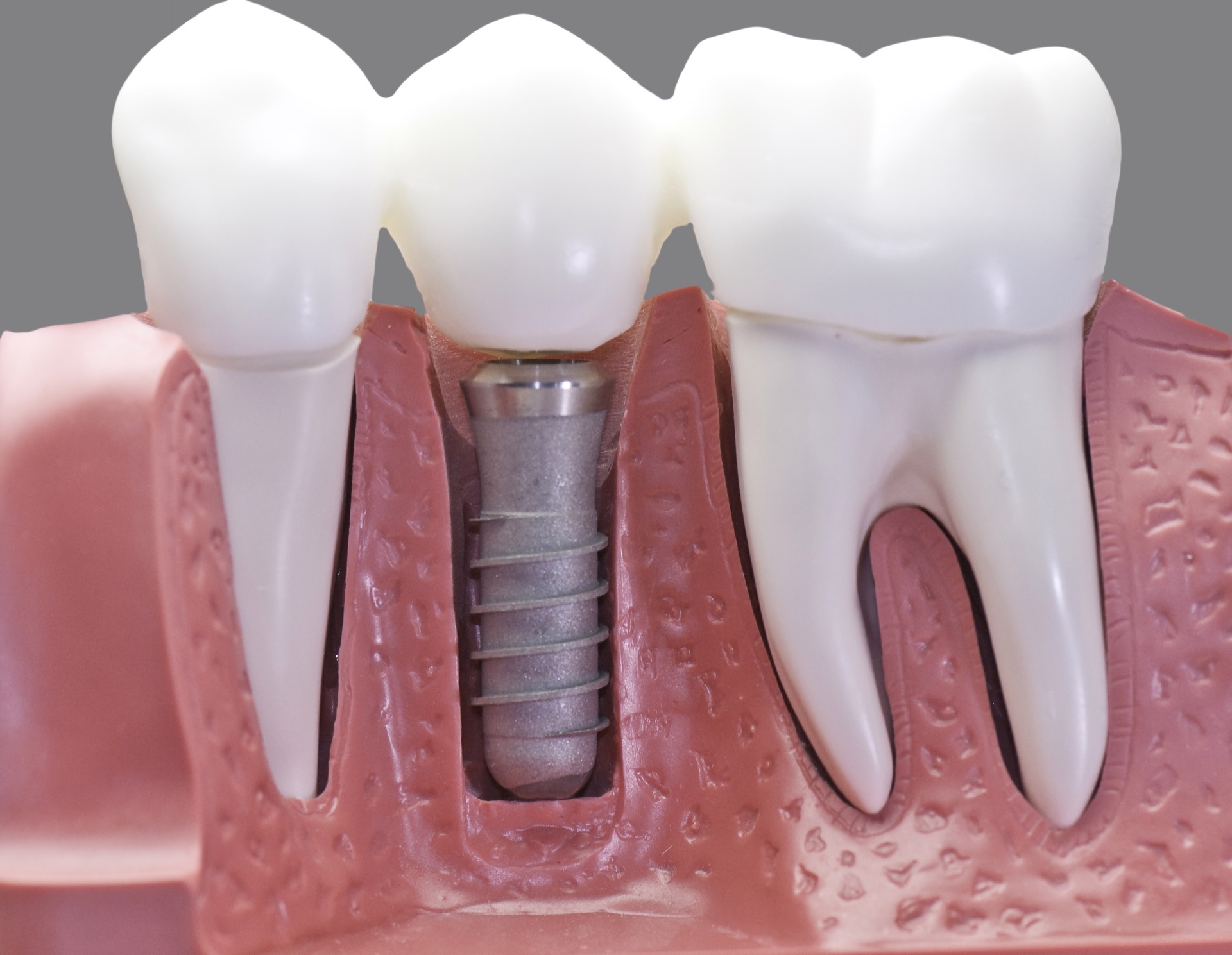 Zobni implantati – kako poteka njihova vsaditev v ustno votlino